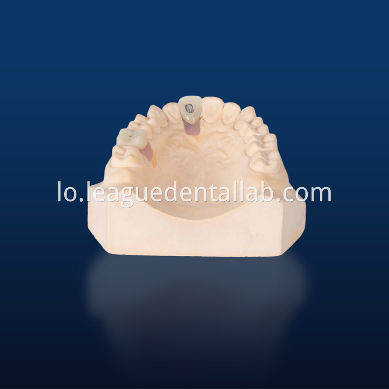 Dental Implant Crown, Dental Implant Zirconia crown,Dental Implant Emax crown,Dental Implant Bridge